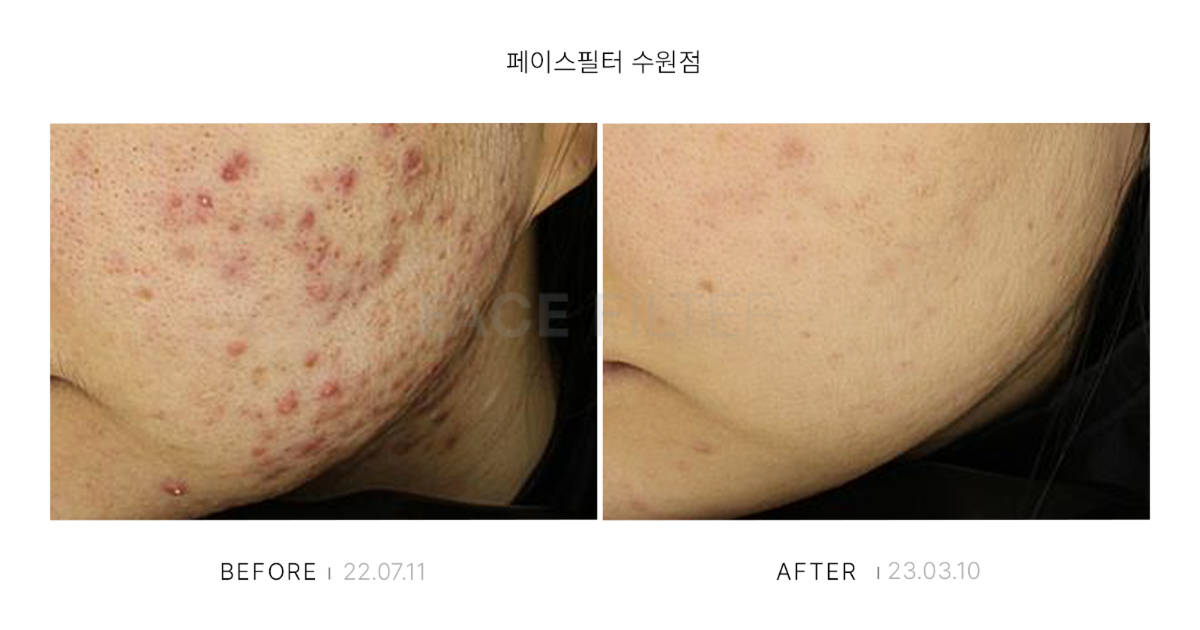 [레이저::PDT]
